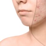 What to Expect at an Acne Treatment Clinic